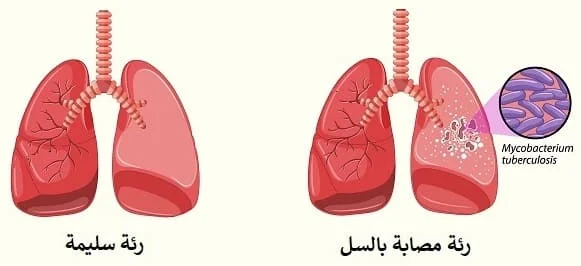 مرض السل