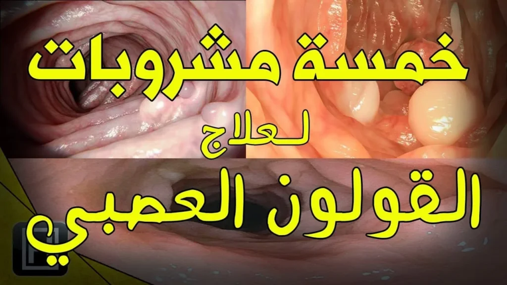5 أعشاب لعلاج القولون العصبي